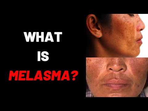 WHAT IS MELASMA?: Causes-Symptoms-Definition-Treatment-Cream-Removal-Tips-Chloasma-Foods-Vitamins