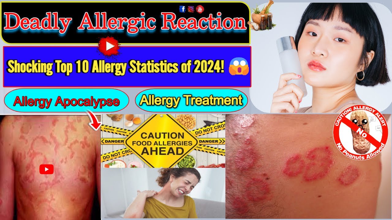 Top 10 Allergy Facts You NEED to Know in 2024 Unveiling the Allergy