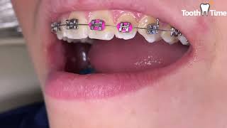 Straight Wire Braces are Creating Lifetime Memories - Westover Family Dental