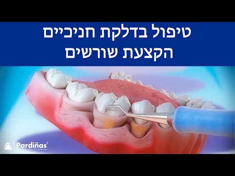 וִידֵאוֹ: 3 דרכים קלות לטיפול בשורש שיניים חשוף