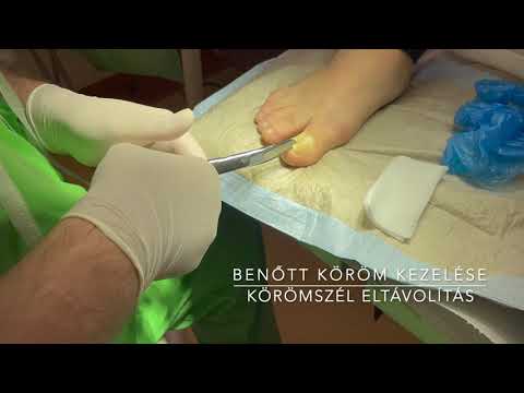 Videó: Benőtt Köröm Műtét: Eljárás és Utógondozás