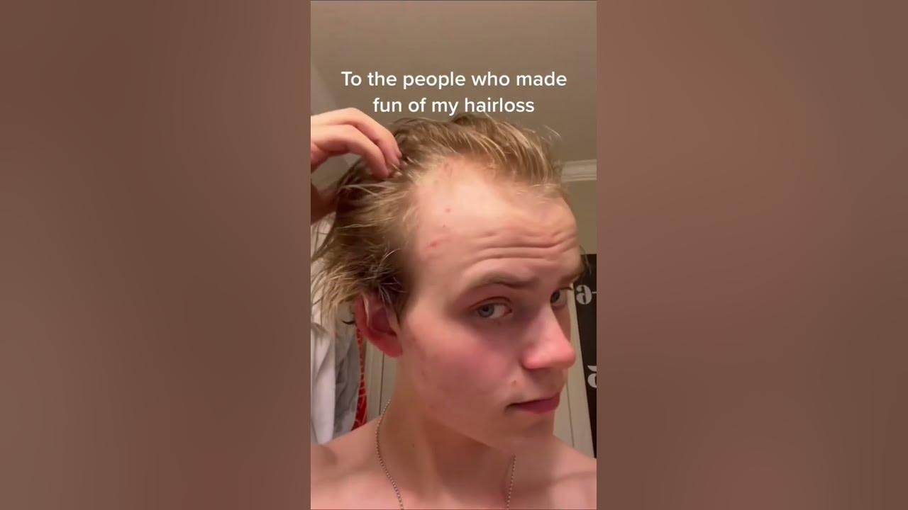 To the people who made fun of my hairloss