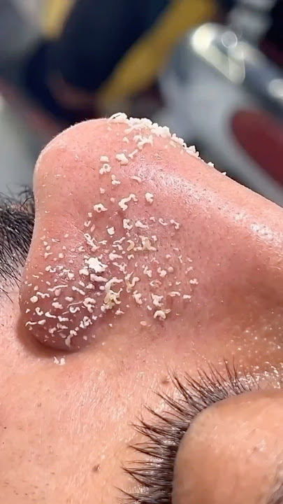 Get Rid Of Blackheads & Whiteheads #blackheads #whiteheads #hack #youtube #diy #video #shorts #viral