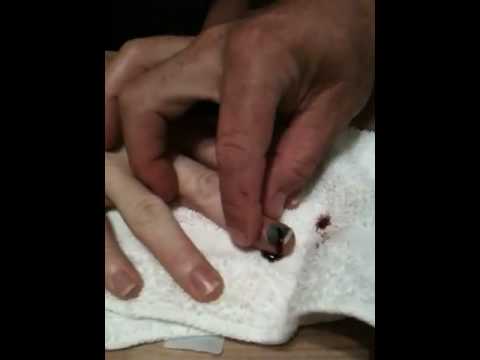 keith pops blood blister under fingernail