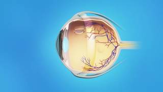 Detached Retina: Vitrectomy with Scleral Buckle