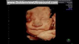 Goldenview HD Live Ultrasound at 35 weeks Yawn