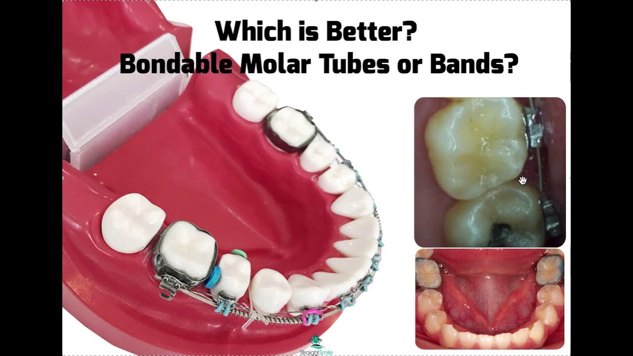 Are Bands or Brackets Better on Molars in Braces? YouTube