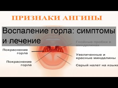 Воспаление горла: симптомы и лечение