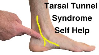 7 Tips for Treating Tarsal Tunnel Syndrome