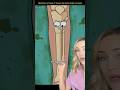 How this surgery makes you taller!