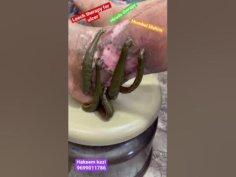 What disease does leech therapy treat? / What is the best treatment for