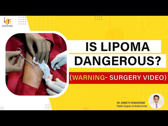 What is Lipoma? Treatment options for removing lipoma| Includes Actual surgery procedure