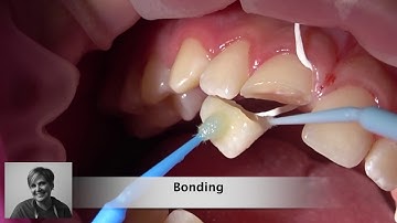 Fragment Reattachment / Crown Fracture  HD 1080p