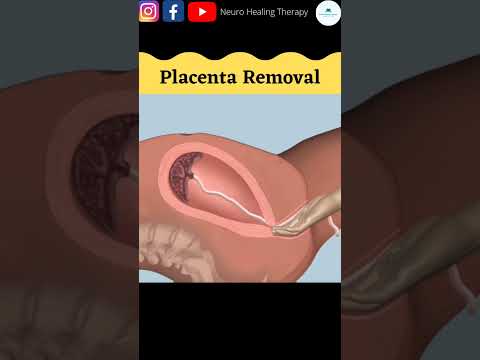 Videó: Mi az a posterior placenta?