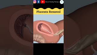 Placenta Removal #shorts #baby screenshot 5