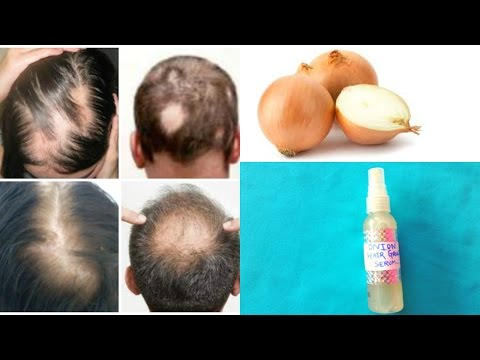 100% Hair Growth (Scientifically Proven)  || Best Hair Loss Treatment For Alopecia & Baldness