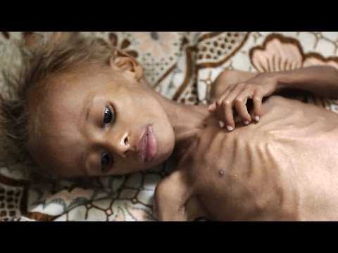 Yemen... Çocuklar açlıktan ölüyor!