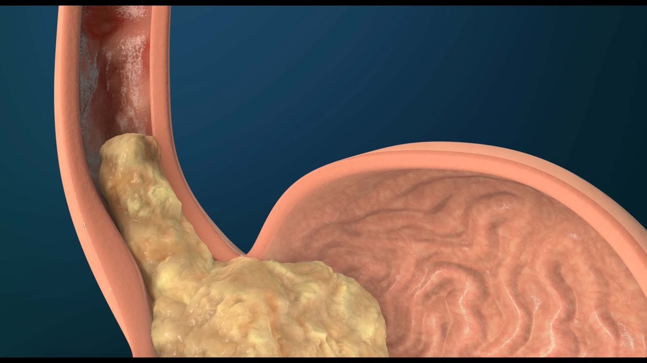 Gastroesophageal Reflux (GERD)