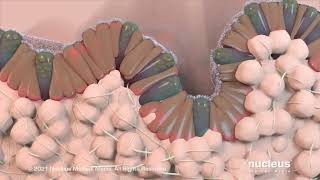 What Causes GERD?