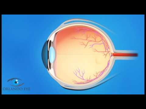 Understanding Glaucoma