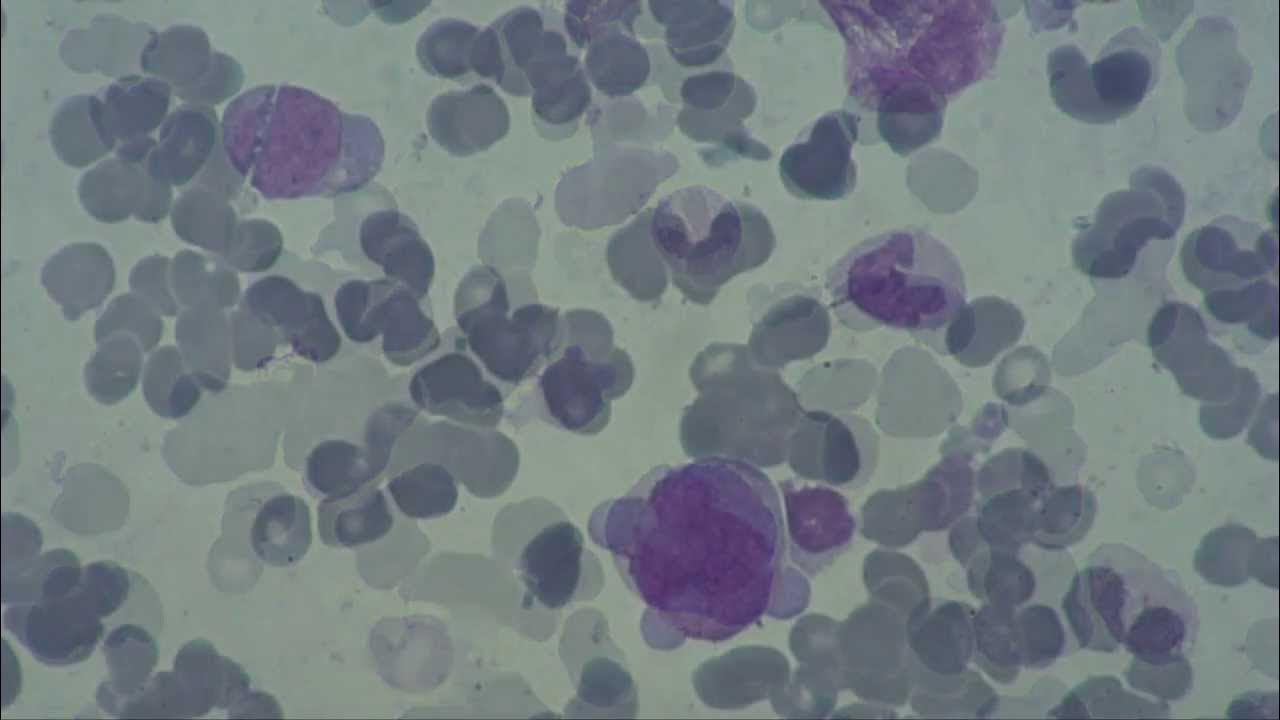 Hematology. Bone Marrow. Hemoblastosis. YouTube