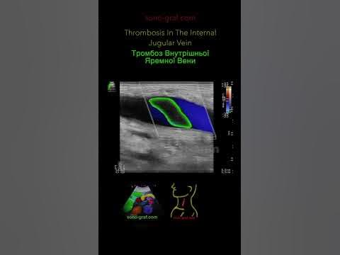 УЗД - Тромбоз Внутрішньої Яремної Вени - YouTube