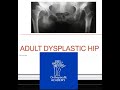 Adult Hip Dysplasia | Acetabular Protrusio - The FRCS Questions। Orthopaedic Academy