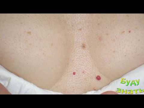 Красные капельки на коже живота, груди  -  Симптом Тужилина указывает на Панкреатит