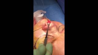 Refining the nasal tip during Rhinoplasty by Dr. Anurag Agarwal