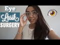 Lasik Laser Eye Surgery | 2 Year Update | Live Surgery Footage!