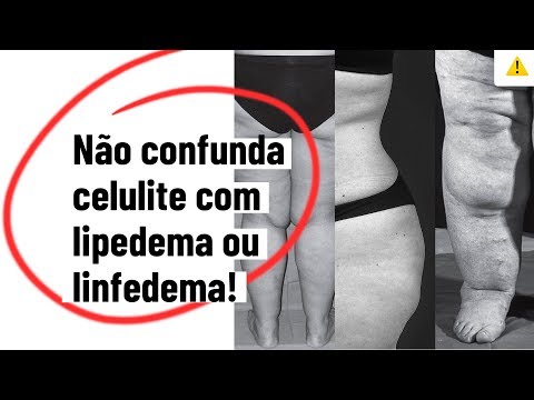 Não confunda CELULITE com LIPEDEMA OU LINFEDEMA! - Pergunte #123