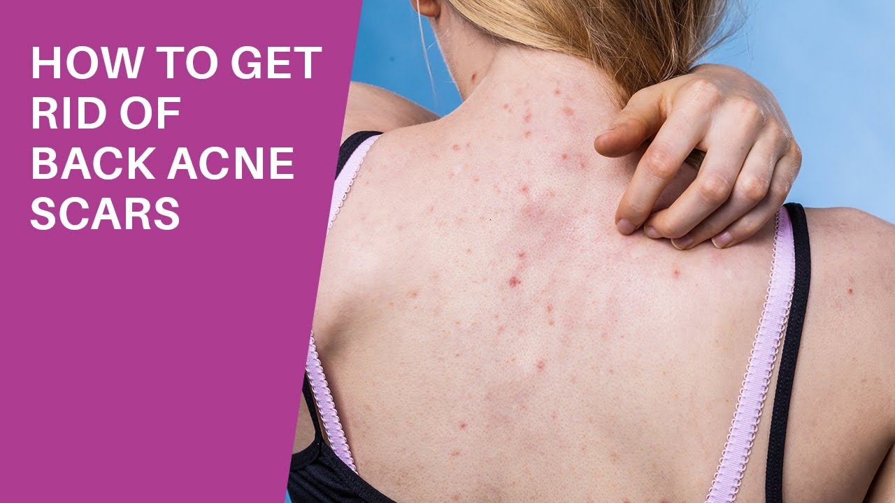 5 Easy Ways To Get Rid Of Back Acne Scars Naturally YouTube