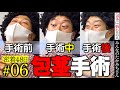 この動画で、包茎手術の理解が超深まる！！包茎手術総集編！(6)