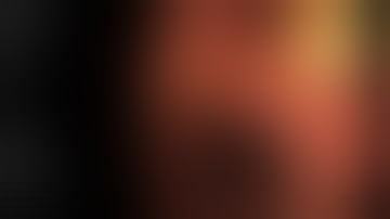 Acute pancreatitis  and cholangitis 2 month after coronary stent placement. Dr Sami Boudabbous.