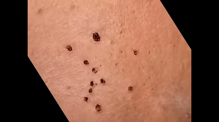 LASER WARTS REMOVAL ( Cautering )