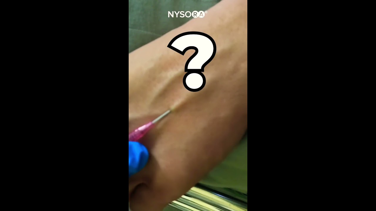 IV Cannulation Gone Wrong 