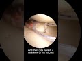 Meniscus Root Tear Surgery: Inside the OR with Dr. Bryan Tan