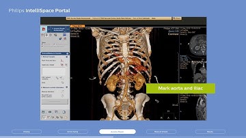 Philips IntelliSpace Portal clinical application CT TAVI planning