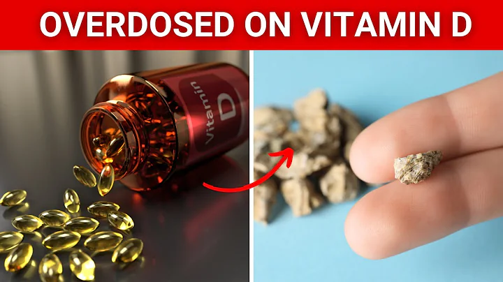 #1 Sign That You Overdosed on Vitamin D