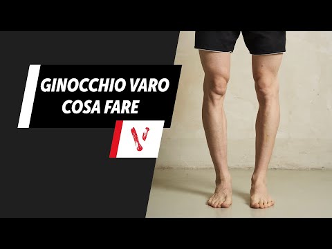 Video: Come Correggere La Curvatura Delle Gambe Con L'esercizio
