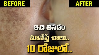 Permanent Soloution For Pigmentation in Telugu || Homemade remedies || Natural Cure for Pigmentation