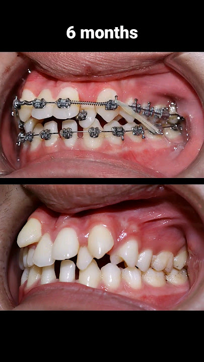 How to braces fix extremely crooked teeth #braces #orthodontist #bracesoff