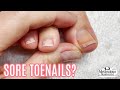 Sore toenails is it impacted or ingrown