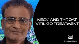 343.neck and throat vitiligo treatment in hindi with English subtitles