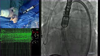 Leading innovation for patients with valvular heart disease - PCR London Valves 2024