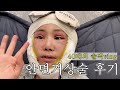 안면거상술 후기 40대 실제상황 vlog (솔직하고 진솔한 부작용, 흉터, 병원 상담까지)