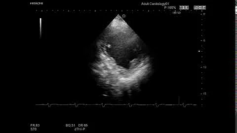 Short axis view of the mid-LV level at the time of LBBB - Supplementary video 3 [ID 269576]