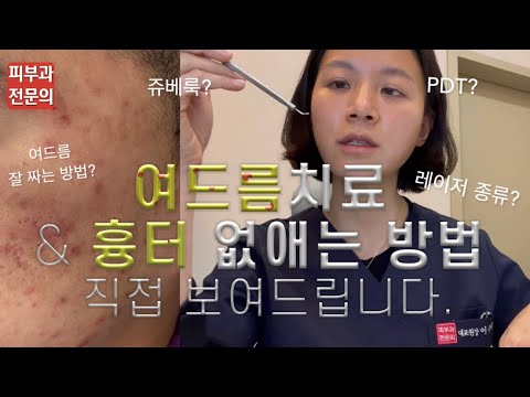 eng. 여드름 치료 & 흉터 없애는 방법 🚨피부과진료 보기 전에 꼭 보고가세요ㅣ피부과 전문의