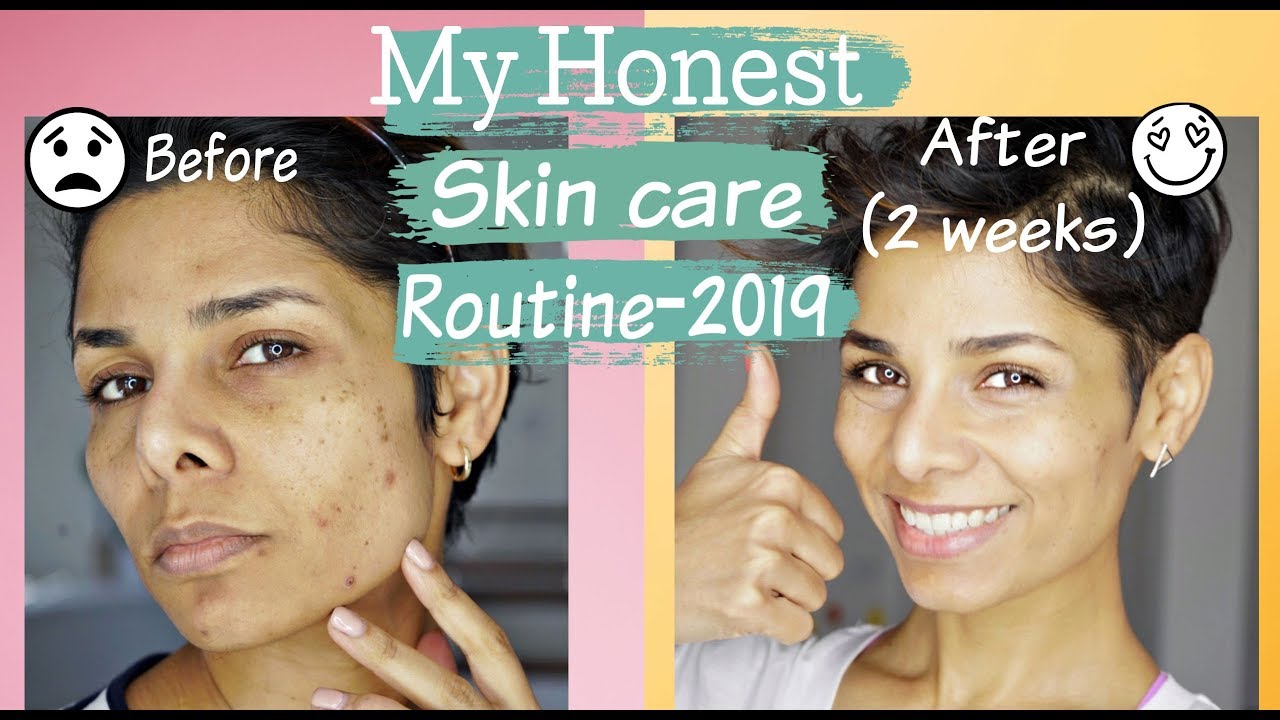 How to Get Rid of Acne, Discoloration and Uneven Skin Tone/ Skin Care  Routine-2019 - YouTube