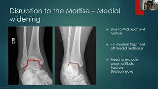 Ankle fracture x-ray interpretation